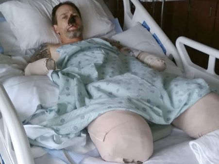 நாய் நக்கியதால் மூக்கு, கை, கால்களை இழந்த எஜமானி.. அமெரிக்காவில் பரிதாபம்!