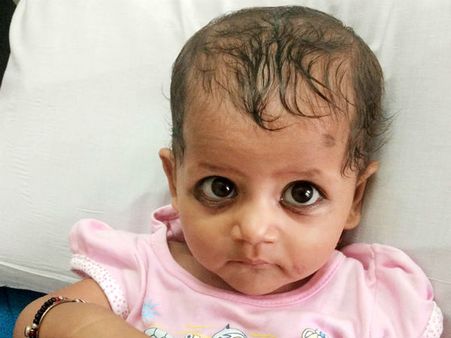 இதய ஓட்டையால் அவதிப்பட்டு பிஞ்சுக்குழந்தை.. சிகிச்சைக்கு உதவுங்கள்!