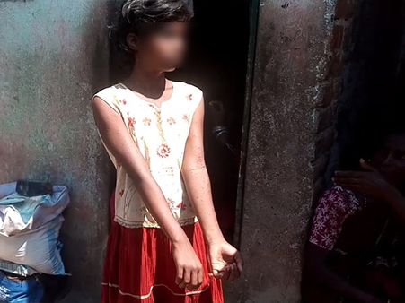 திடீரென வெடித்த நாட்டு வெடி குண்டு.. நடந்து சென்ற சிறுமி படுகாயம்.. சென்னையில் பரபரப்பு