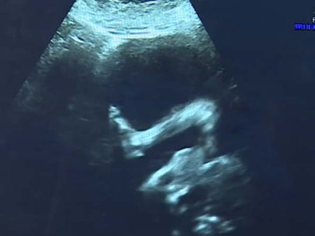 கருவில் இருந்த சிசுவுக்கு முதுகெலும்பு ஆபரேஷன்.. லண்டன் மருத்துவர்கள் புதிய சாதனை