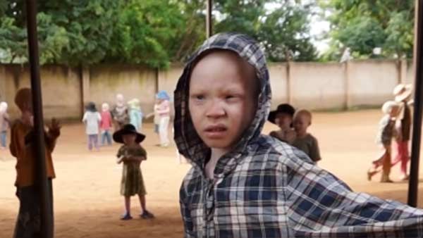 அல்பீனிய நோயால் குழந்தைகள் பாதிப்பு.. மூடநம்பிக்கையால் உறுப்புகள் திருட்டு.. அதிர்ச்சி ரிப்போர்ட்