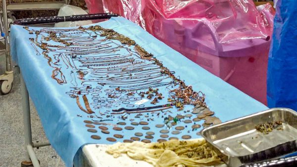 பெண்ணின் வயிற்றுக்குள் வளையல், மூக்குத்தி, நாணயங்கள் - அதிர்ச்சியடைந்த டாக்டர்கள்