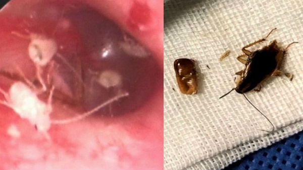 மீதமான சாப்பாட்டால் வந்த வினை.. இளைஞரின் காதுக்குள் கும்பலாக குடும்பம் நடத்திய கரப்பான்பூச்சிகள்!