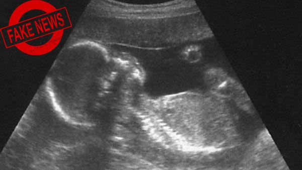 வயிற்றில் இருக்கும் குழந்தை ஆணா, பெண்ணா என்று பார்க்க விதித்த தடை விலக்கப்படவில்லை.. அரசு விளக்கம்