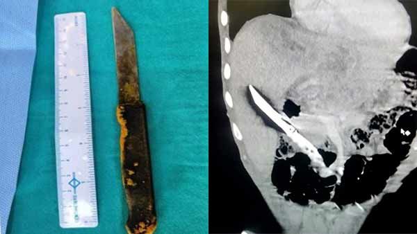 கஞ்சா போதையில் கத்தியை விழுங்கிய இளைஞர் - கல்லீரலில் இருந்ததை ஆபரேசன் செய்த டாக்டர்கள்