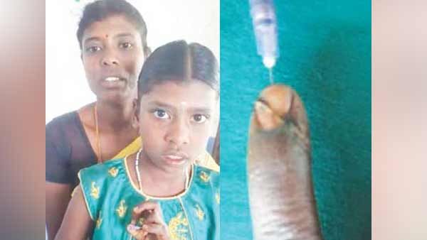 சிறுமியின் துண்டான விரலை சரி செய்த அரசு மருத்துவமனை... டாக்டருக்கு குவியும் பாராட்டு