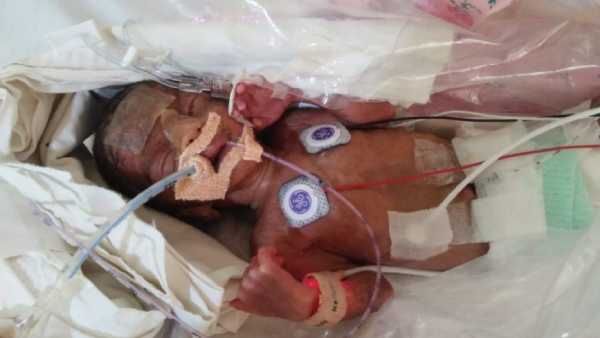 பிறந்து 1 மாசம்தான் ஆகிறது.. பச்சிளம் குழந்தைக்கு இதயத்தில் பிரச்சினை.. உடனே உதவுங்களேன்