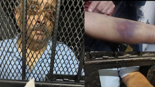 கையில் ரத்தக் கட்டு.. வீங்கி சிவந்த கண்களுடன் டொமினிகா சிறையில் காட்சியளிக்கும் மெகுல் சோக்ஷி!