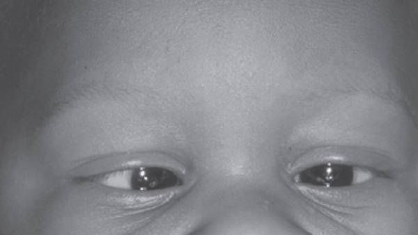 குழந்தைகளிடையே திடீரென அதிகரிக்கும் மாறுகண்....இதுதான் காரணம்...எச்சரிக்கும் கண் மருத்துவர்