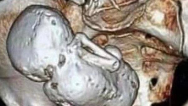 35 ஆண்டுகளாக வயிற்றில் கல் குழந்தையுடன் 73 வயது மூதாட்டி.. லித்தோபீடியன் என்றால் என்ன?