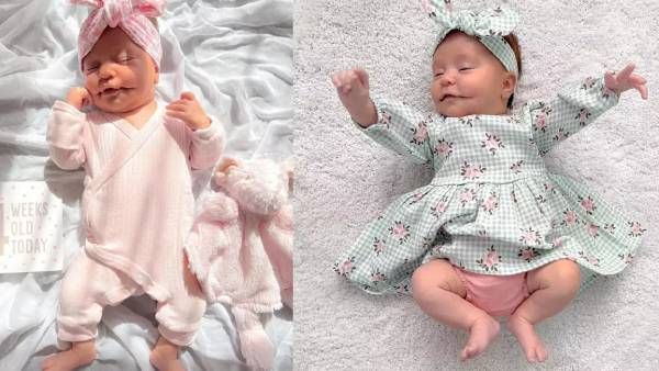 நிரந்தர சிரிப்புடன் ஆஸ்திரேலியாவில் பிறந்த பெண் குழந்தை.. மிக மிக அபூர்வமான நோயாம்