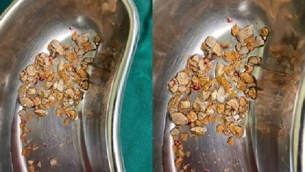 வயிறா இல்லை குவாரியா? கிட்னியில் 206 சிறுநீரக கற்கள்..! தலைசுற்றிப் போன மருத்துவர்கள்? என்ன ஆச்சு..?