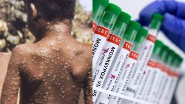 கொரோனா போல பரவுமா மங்கி பாக்ஸ்? வேக்சின் உள்ளதா? இந்தியாவில் என்ன நிலை? ஐசிஎம்ஆர் முக்கிய விளக்கம்