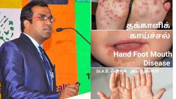 தக்காளி காய்ச்சல் வந்தால் என்ன செய்ய வேண்டும்? எதை செய்யக் கூடாது! அரசு டாக்டரின் முக்கிய டிப்ஸ்!