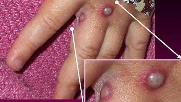 தாவி வரும் ‘குரங்கு காய்ச்சல்”! இத்தனை நாடுகளில் பாதிப்பா? மாநிலங்களை அலர்ட் செய்யும் மத்திய அரசு!