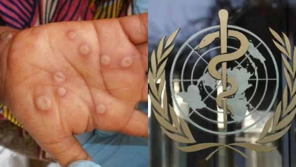 கொரோனாவை போலவே மங்கி பாக்ஸ்? அப்போ இது தான் அடுத்த பெருந்தொற்றா! சில நாட்களில் WHO முக்கிய ஆலோசனை