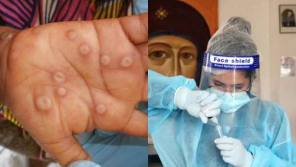 30 நாடுகளில் 700 பேர் பாதிப்பு! தீயாய் பரவும் குரங்கு அம்மை! இப்படி கூட பரவும்! நிபுணர்கள் வார்னிங்!