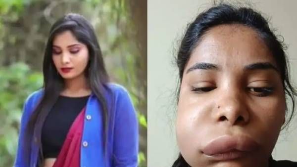 ரூட் கேனால் சிகிச்சையால் பிரபல நடிகையின் முகம் வீங்கியது ஏன்?.. மருத்துவர் இத்தனை கவனக்குறைவா?