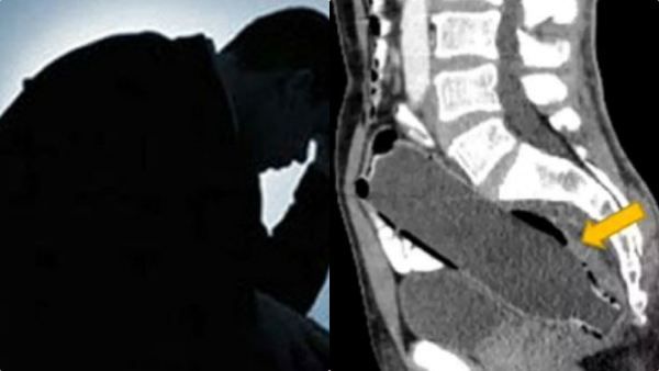 அந்த இடத்தில் சிக்கிய வாட்டர்பாட்டில்.. மனைவிக்கு பயந்து டாக்டரிடம் உண்மையை மறைத்த கணவர்!