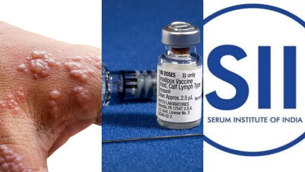 குரங்கு அம்மை நோய்க்கு தடுப்பூசி எப்போது? சீரம் நிறுவனம் அளித்த முக்கிய அப்டேட்