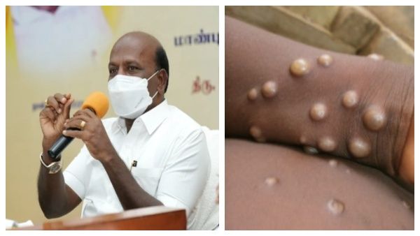 தமிழகத்தில் குரங்கு அம்மை பாதிப்பு இல்லை..பதற்றம் அடைய வேண்டாம்.. மா.சுப்ரமணியன் தகவல்