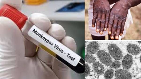 2 நாளில் 2 பலி! தீவிரமாகும் குரங்கு அம்மை! மேற்கத்திய நாடுகளில் உச்சகட்ட அலர்ட்! கண்காணிப்பு தீவிரம்