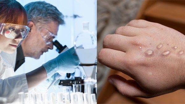 டெல்லியை தொடர்ந்து தெலுங்கானாவில் முதல் முறையாக ஒருவருக்கு குரங்கு அம்மை தொற்று