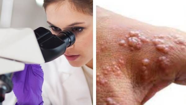 ஜாக்கிரதை தேவை மக்களே! கேரளாவில் மங்கி பாக்ஸ் உறுதி! தமிழகத்தில் பரவாமல் இருக்க நடவடிக்கை தீவிரம்