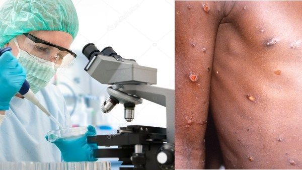 கொரோனா vs குரங்கு அம்மை! எது அதிக ஆபத்து? மருத்துவ நிபுணர்கள் விளக்கம்