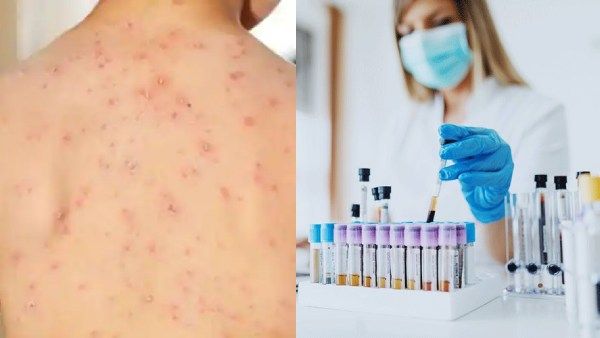 புதுக்கோட்டையில் குரங்கு அம்மை? சிங்கப்பூரில் இருந்து வந்த இளைஞருக்கு அறிகுறிகள்.. அதிர்ச்சி!