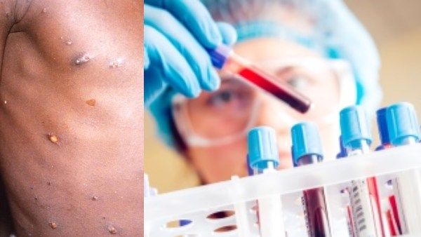 ஓரினச் சேர்க்கையால் பரவும் குரங்கு அம்மை? உண்மை என்ன? அறிகுறிகள் என்னென்ன? முழுமையான தகவல்கள் இதோ!