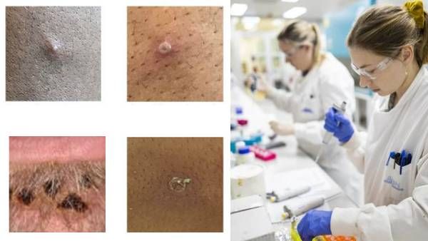 குரங்கு அம்மை அறிகுறிகள் என்ன? யாரையெல்லாம் எளிதில் தாக்கும்? பாதுகாப்பாக இருப்பது எப்படி? முழு விவரம்