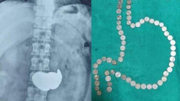 'இளைஞரின் வயிற்றுக்குள் 63 ஒரு ரூபாய் நாணயங்கள்'. . மிரண்டுபோன டாக்டர். . ராஜஸ்தானில் சம்பவம்!