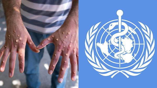 புதிய பிரச்சனை! இது வேறயா? திடீரென உருமாற்றம் அடையும் குரங்கு அம்மை? WHO சொல்வது என்ன?