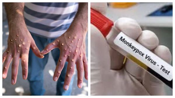 டெல்லியில் மேலும் ஒருவருக்கு குரங்கு அம்மை.. நாடு முழுக்க மொத்த பாதிப்பு 8 ஆக உயர்வு!