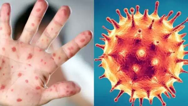 கொரோனா, மங்கி பாக்ஸ் என தொற்று நோய்கள் அதிகரிக்க இது தான் காரணம்! அடித்துச் சொல்லும் ஆய்வாளர்கள்