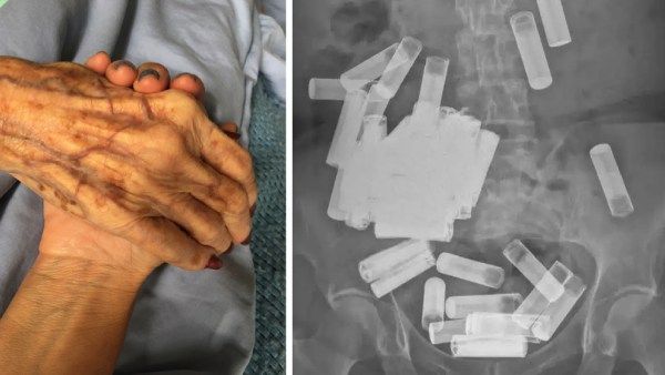 ஒன்று.. இரண்டல்ல.. 'அயர்லாந்தில் 50 பேட்டரிகளை விழுங்கிய மூதாட்டி'.. மருத்துவர்கள் மீட்டது எப்படி?