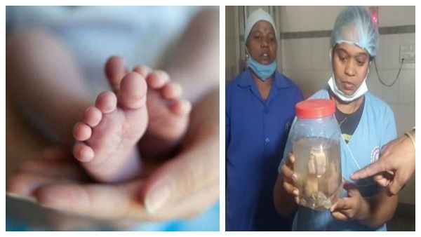 பிறந்து 21 நாட்களே ஆன சிசுவின் வயிற்றில் 7 கருக்கள்.. வியந்து போன மருத்துவர்கள்.. எப்படி நடந்தது?