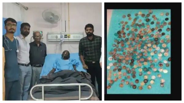 முதியவர் வயிற்றில் என்ன இது? கல்லா பெட்டியா? 187 நாணயங்களை எடுத்த மருத்துவர்கள்.. ஷாக் காரணம்