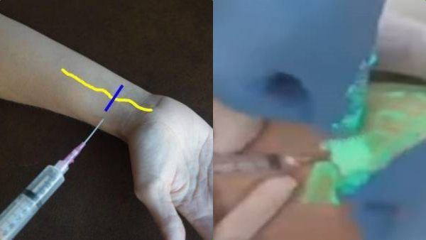 இனி ஈசி ஊசி.. நரம்பை கண்டறிய வந்துவிட்டது புதிய தொழில்நுட்பம்.. 