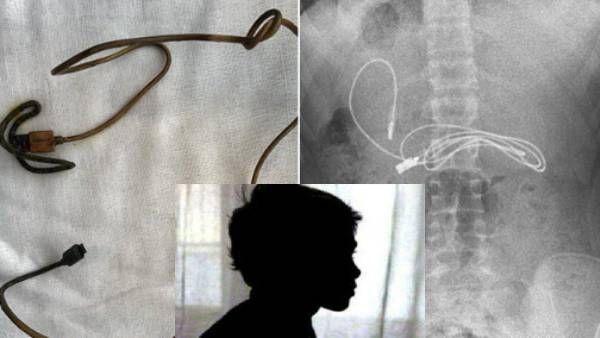 வயிற்று வலியால் துடித்த சிறுவன்..எக்ஸ் ரே எடுத்து பார்த்தால் 'சார்ஜிங் கேபிள்..ஷாக் ஆன மருத்துவர்கள்