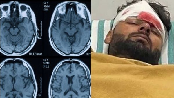 ரிஷப் பண்ட் எப்படி இருக்கிறார்? மூளையில் எம்ஆர்ஐ ஸ்கேன்.. ரிப்போர்ட் சொல்வது என்ன?