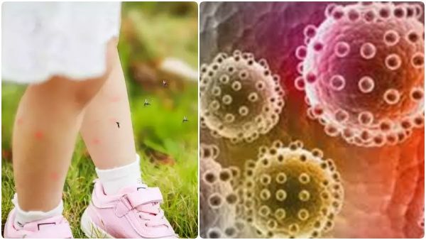 கர்நாடகாவில் புகுந்த ஜிகா வைரஸ்! உயிரிழப்பு ஏற்படுமா? குழந்தைகள் ரொம்பவே ஜாக்கிரதை! அறிகுறிகள் என்ன