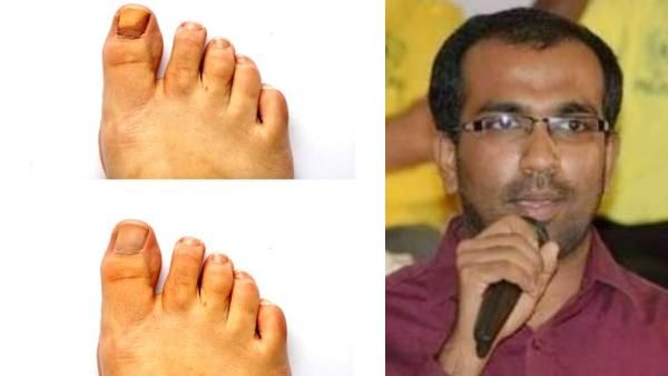 சர்க்கரை நோயாளிகளுக்கு சேற்று புண்ணா? விட்டீங்க உறுப்பை மட்டுமில்ல உயிரையே எடுக்கும்.. டாக்டர் பரூக் 