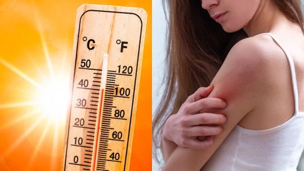 கோடைக்காலத்தில் அதிகரிக்கும் வெப்பம்.. தோல் நோய்கள் ஏற்படாமல் பாதுகாப்பது எப்படி?