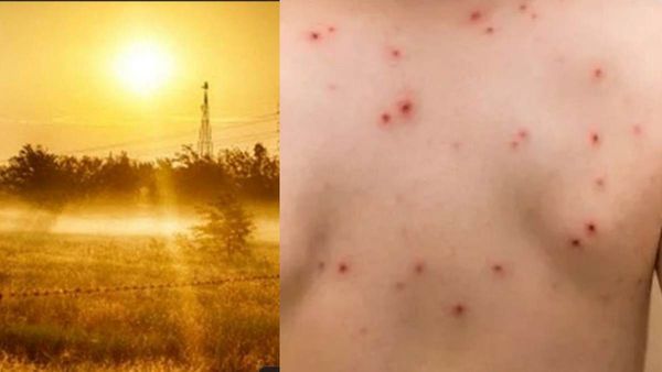 வெயில் காலத்தில் அம்மை நோய் எதனால் வருகிறது?...வராமல் காத்துக்கொள்வது எப்படி?