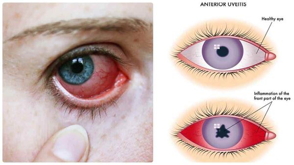 சிவந்து சிவந்து போகும் கண்கள்.. சென்னை மக்களே உஷார்.. இதுதான் பிரச்சனையே.. பறந்துவந்த அட்வைஸ்..!!