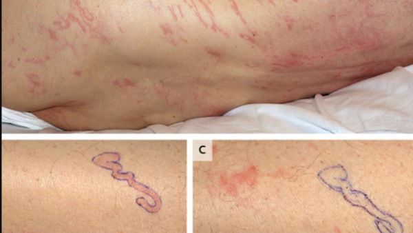 தோலில் ஊடுருவி நெளிந்த புழுக்கள்.. மருத்துவமனையில் அனுமதிக்கப்பட்ட தூய்மை பணியாளர்!