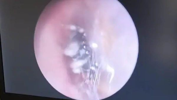 காது வலியால் துடித்த பெண்.. எண்டோஸ்கோபி செய்த டாக்டர்கள்.. கூடு கட்டி இருந்த சிலந்தி.. ஷாக்!