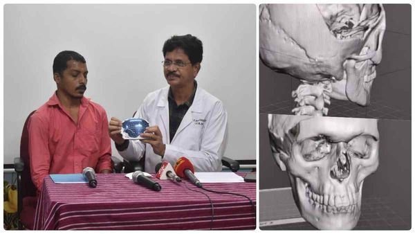 ஒரே நாளில் மூன்று பேருக்கு.. சத்தமே இல்லாமல் சம்பவம் செய்த சென்னை அரசு மருத்துவமனை மருத்துவர்கள்